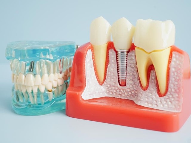 5 mitos sobre los implantes dentales que debes conocer