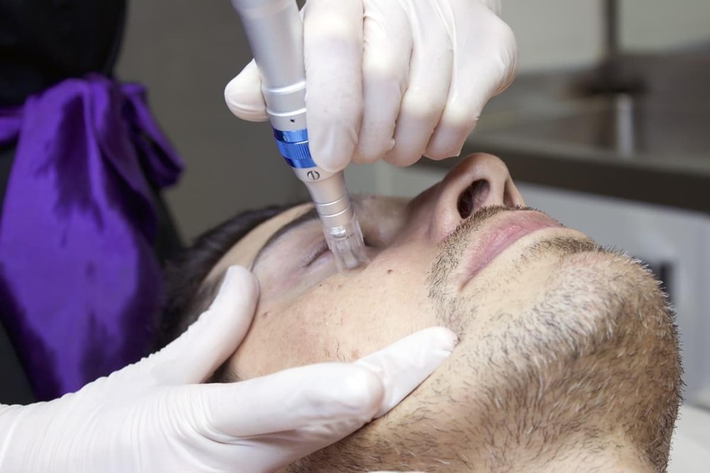 Cómo conseguir un rostro más luminoso y terso con el microneedling